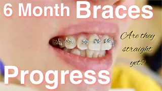 6 months braces progress in less than 2 minutes   Video and phone time lapse