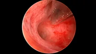 Polypectomy & Endometrial sampling