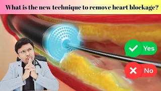 "Laser Angioplasty: Breakthrough Technique for Heart Blockage Removal! 💥