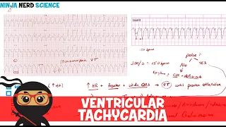 Rate and Rhythm | Ventricular Tachycardia