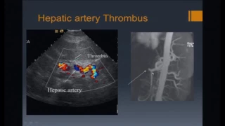 Imaging of Liver Transplants