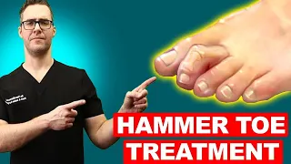 Hammer Toe Exercises, Stretches & Treatment [Claw Toes & Mallet Toes!]