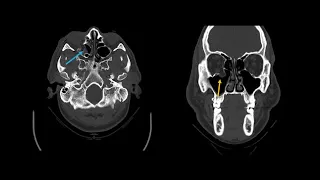 Describing the typical appearance of skull fractures as seen on computed tomography (CT) imaging