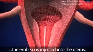 Embryo Transfer