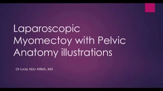 Laparoscopic Myomectomy with Pelvis Anatomy Illustrations