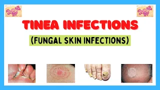Tinea infection (fungal skin infection), types, risk factors, pathophysiology, diagnosis, treatment