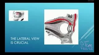 Eyelid Ptosis From Botulinum Toxins - Understanding The Crucial Anatomy.