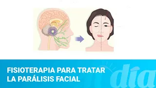 Fisioterapia para tratar la parálisis facial