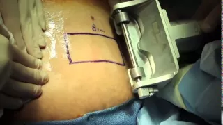 Live Surgery Split Thickness Skin Graft.m4v