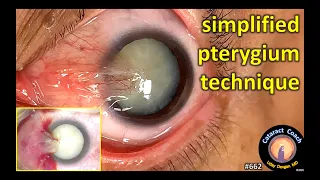 simplified technique for safe pterygium surgery