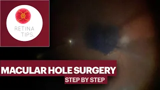 Macular Hole Surgery   Step by Step