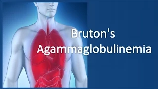 Bruton's agammaglobulinemia