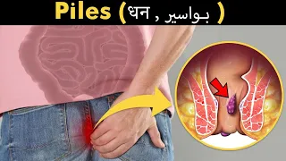 What Happens In Piles (Haemorrhoids, Bawaseer (بواسیر) | Symptoms, Causes And Treatment (Urdu/Hindi)