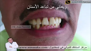 بسبب سمعتي الطيبه وأسعار زراعة الأسنان المعتدلة طبيب أخصائي في مستشفى التخصص الرياض يزرع ويركب أسنان