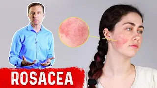 What Can Be Done for Rosacea