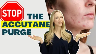 Accutane Acne Purge? Do THIS