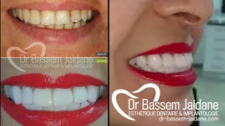 facettes dentaires veneers E-Max tunisie