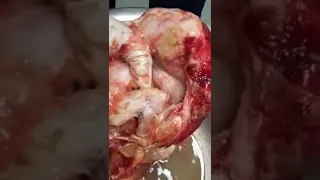 Foetus in fetu - A rare teratoma specimen dissection