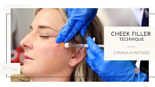 Cheek Filler Technique with Cannula I Breakdown