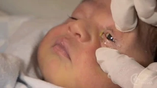 Eye Infections - Newborn Care Series
