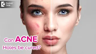 Are acne holes permanent? 5 Ways to cure ACNE HOLES - Dr. Rashmi Ravindra | Doctors' Circle