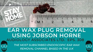 EAR WAX REMOVAL USING JOBSON HORNE - EP 308