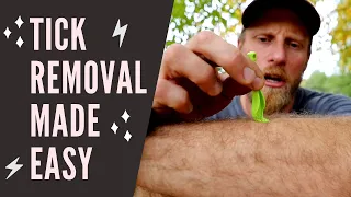 How to Remove a Ticks at Camp Safely!