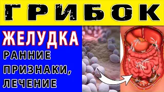 ГРИБОК ЖЕЛУДКА - РАННИЕ ПРИЗНАКИ МИКОЗА, ЛЕЧЕНИЕ 👍