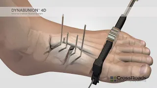 dynaBunion™ 4D Minimal-Incision Lapidus System - Surgical Animation