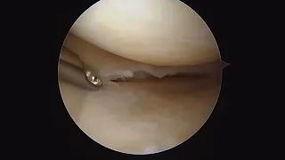 Knee Arthroscopy - Partial medial menisectomy for a tear of the meniscus