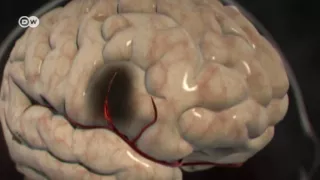 ¿Cómo tratar un accidente cerebrovascular? | En forma