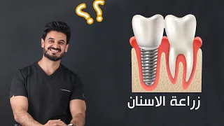 زراعة الأسنان- توضيح خطوات العمل — dental implant indications and benefits