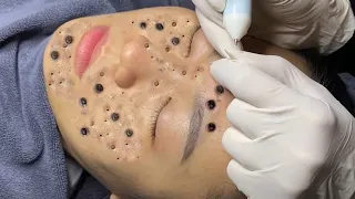 Make your Acne Treatment Huong Da Nang​ | acne 2022 Part3