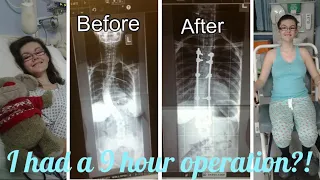 MY SCOLIOSIS STORY!! I had a 9 hour operation...