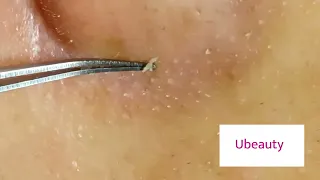 No squeezing whiteheads removal (Facial 33 left nose)
