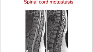 imaging of spinal tumors