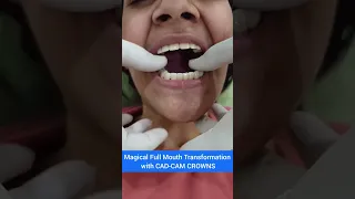 Magical Full Mouth Transformation with CAD CAM crowns - Dr. Srishti Bhatia