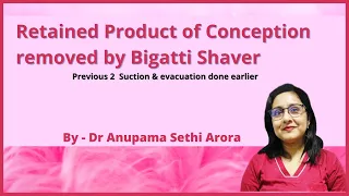 Retained product of conception removed by Bigatti Shaver - Dr Anupama Sethi Arora