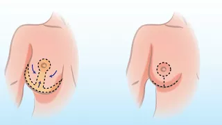 How A Breast Reduction Surgery Works with Dr. Smith