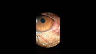 Metallic particle removed from eye | Corneal Foreign body removal