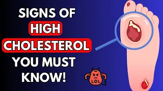 5 Most common but ALARMING signs of HIGH CHOLESTEROL | Nourish Hub