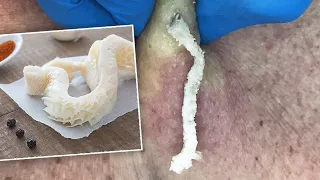 Gritty Tripe-Like Cyst Squeezed Out | CONTOUR DERMATOLOGY