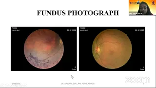 AIOC2021-FP36-DR.APOORVA  GOEL-Unilateral Atypical Retinitis Pigmentosa in a 65 years old female