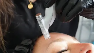 EVO PEN MICRONEEDLING (COLLAGEN INDUCTION THERAPY)   |   AVISSA SKIN