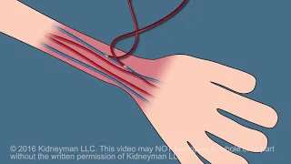 Dialysis Fistula animation