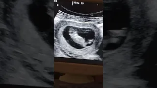 ultrasound fetal anomaly  Anencephaly 11 weeks