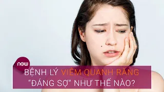 Bệnh lý viêm quanh răng “đáng sợ” như thế nào? | VTC Now