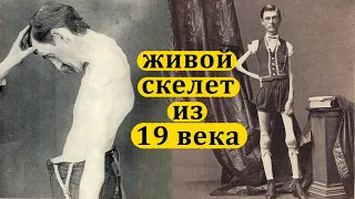 ЖИВОЙ СКЕЛЕТ из 19-го века. ИСААК СПРЭГ и его Уникальная история