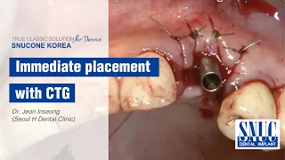 [SUNCONE IMPLANT] Immediate placement with CTG