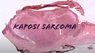 Nodular Kaposi sarcoma under the microscope (pathology dermpath dermatology dermatopathology)